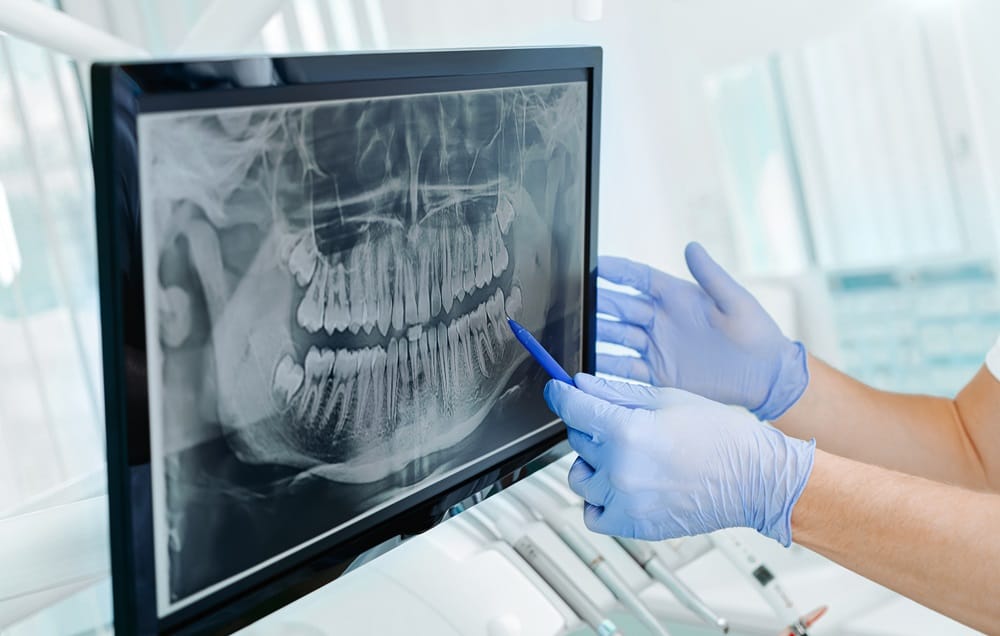 Dental X-ray Analysis – Dentist in San Mateo Dentist analyzing a dental X-ray on the screen, pointing out areas of interest — Dentist in San Mateo.