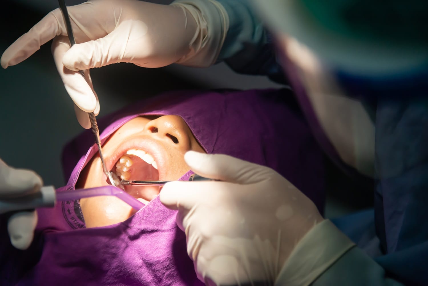 A patient undergoing a dental procedure with gloved professionals using dental tools inside the open mouth, likely for wisdom tooth extraction – Wisdom Teeth Removal San Mateo
