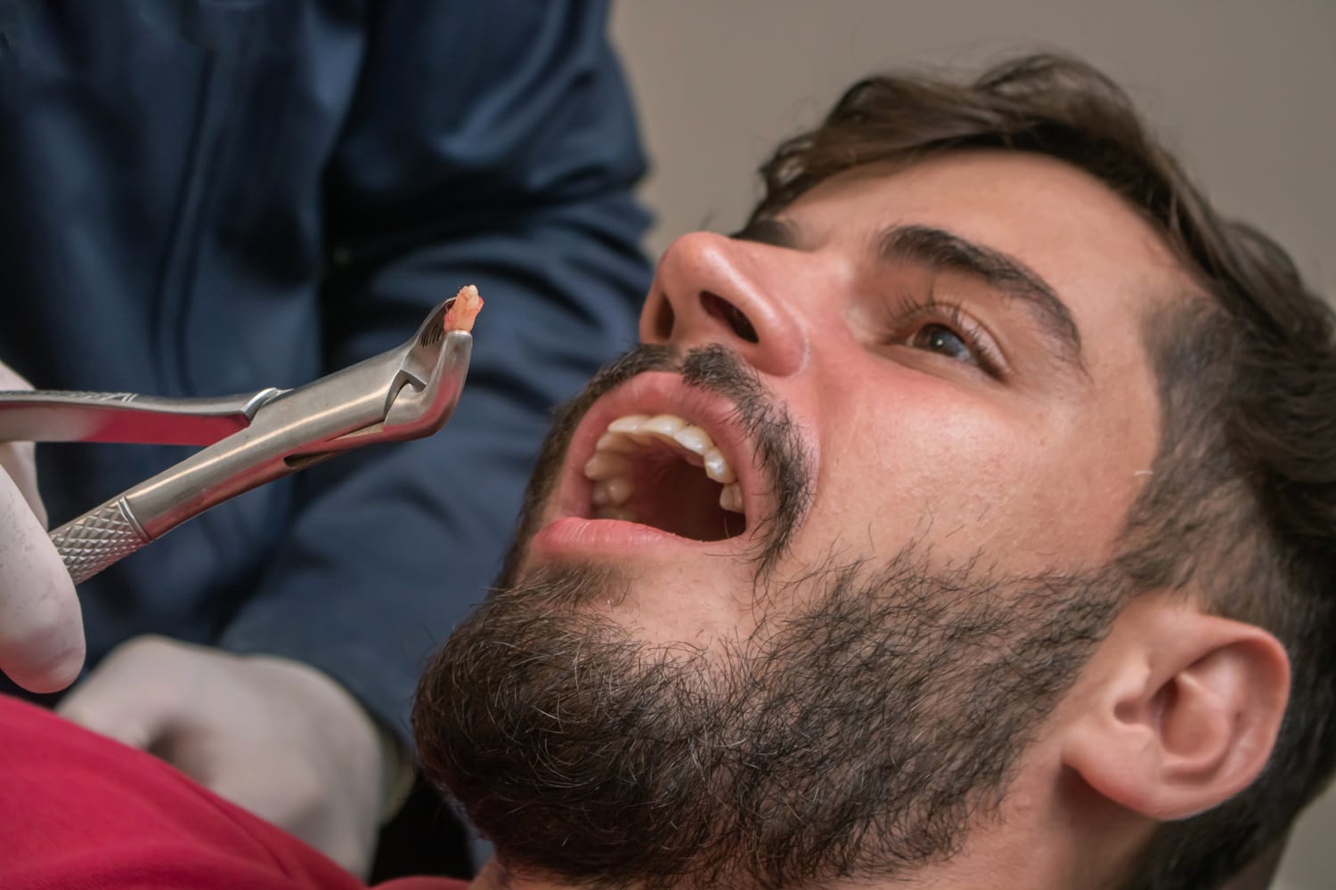 Tooth Extraction Procedure — Dentist in San Mateo A dentist holding extracted tissue or tooth fragment with forceps while a male patient lies with his mouth open - Dentist in San Mateo